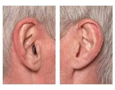 Vergleich zwischen Hörgerät im Ohr und Hörgerät hinter dem Ohr